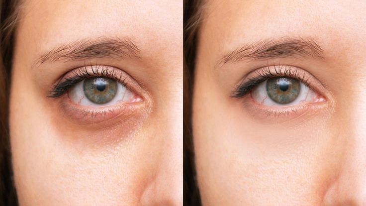 Xóa Quầng Thâm Mắt